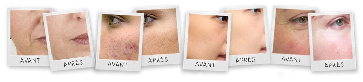 banniere montrant des photos de femmes ayabt utilisé le derma roller banniere montrant des photos de femmes ayabt utilisé le derma roller