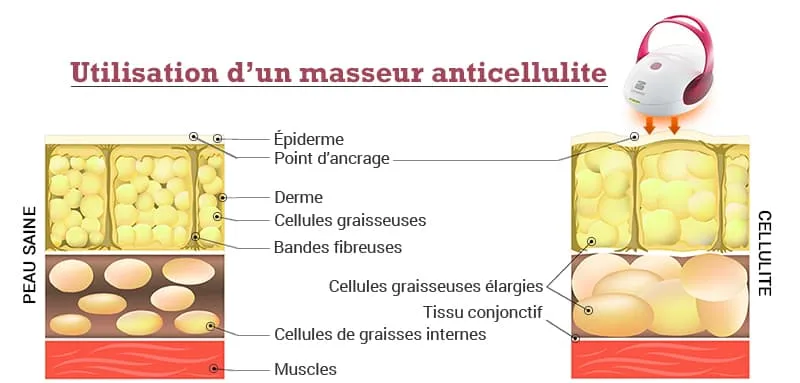 infographie presentant le masseur anticellulite silkn et ses effets