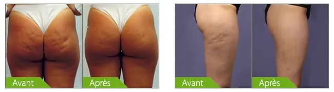 quatre photos de jambes avec de la cellulite avant après