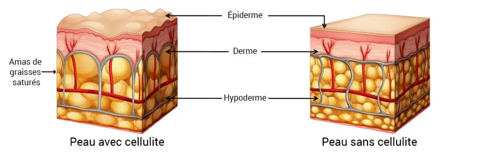 infographie montrant la différence entre un peau cellulitée et une peau non cellulitée