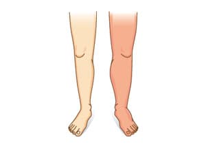 deux jambes de couleur differentes gonflements rétention d'eau